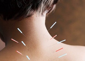 acupuncture_neck_whiplash